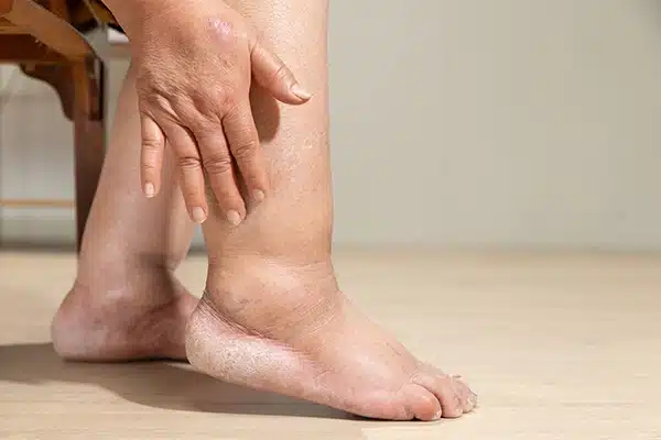 Ilustrasi sistem limfatik yang menunjukkan penyebab tubuh bengkak akibat penumpukan cairan (edema)